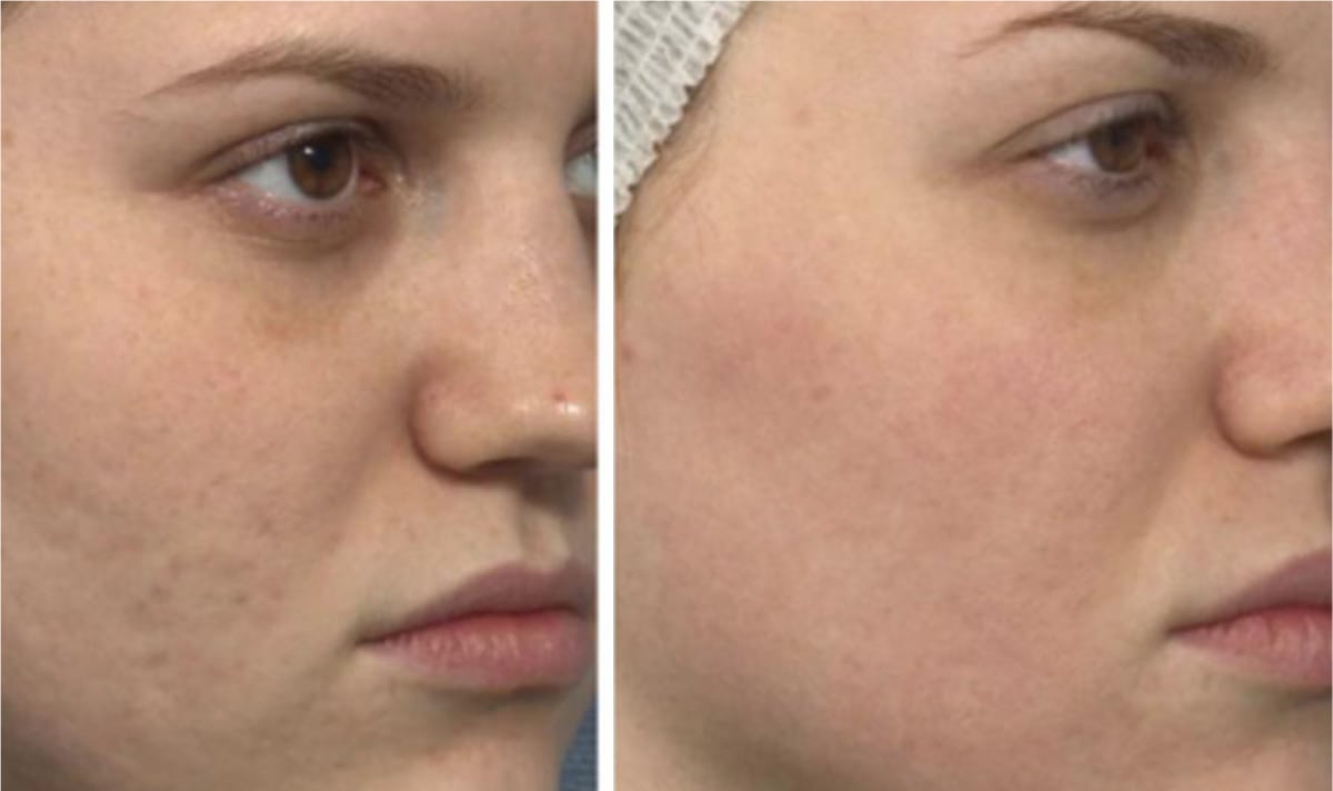 Soins Skin Ethik contre les marques et cicatrices d'acné