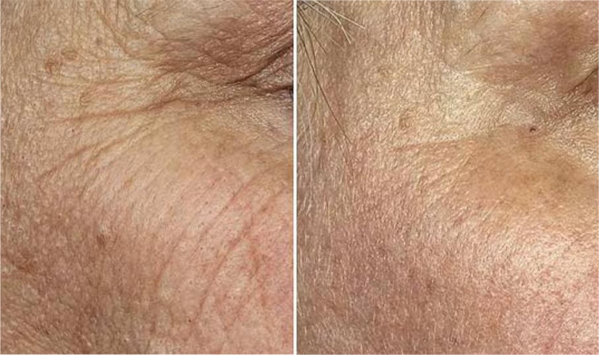 Traitement Skin Ethik pour réduire les ridules